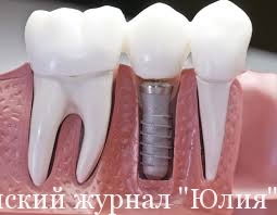chto-takoe-implantaciya-zubov