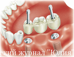 Современные технологии несъемного протезирования зубов