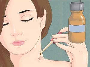 Как избавиться от папилломы на шее