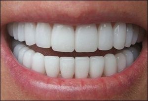 Особенности зубного протезирования