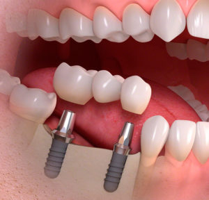 Имплантация зубов в Москвев -